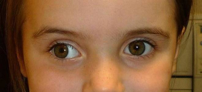 Как вылечить расходящееся косоглазие у взрослого?