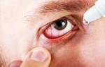 Глазные капли при конъюнктивите у взрослых с антибиотиком