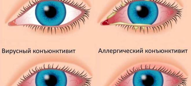 Ячмень на глазу на латыни