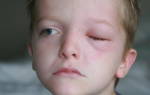 Что такое блефарит глаз у детей?