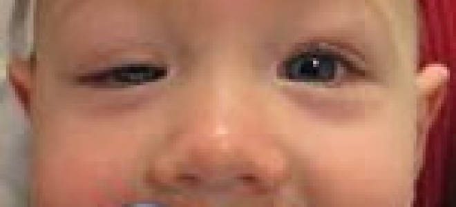 Почему опускаются веки на глазах глаза не болят?