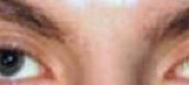 Можно ли вылечить косоглазие без операции?