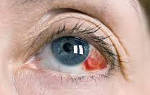 Кровоизлияние в глазу при конъюнктивите