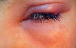 Болезнь глаз у детей ячмень