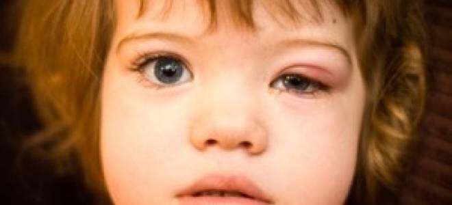 Постоянно выскакивает ячмень на глазу у ребенка